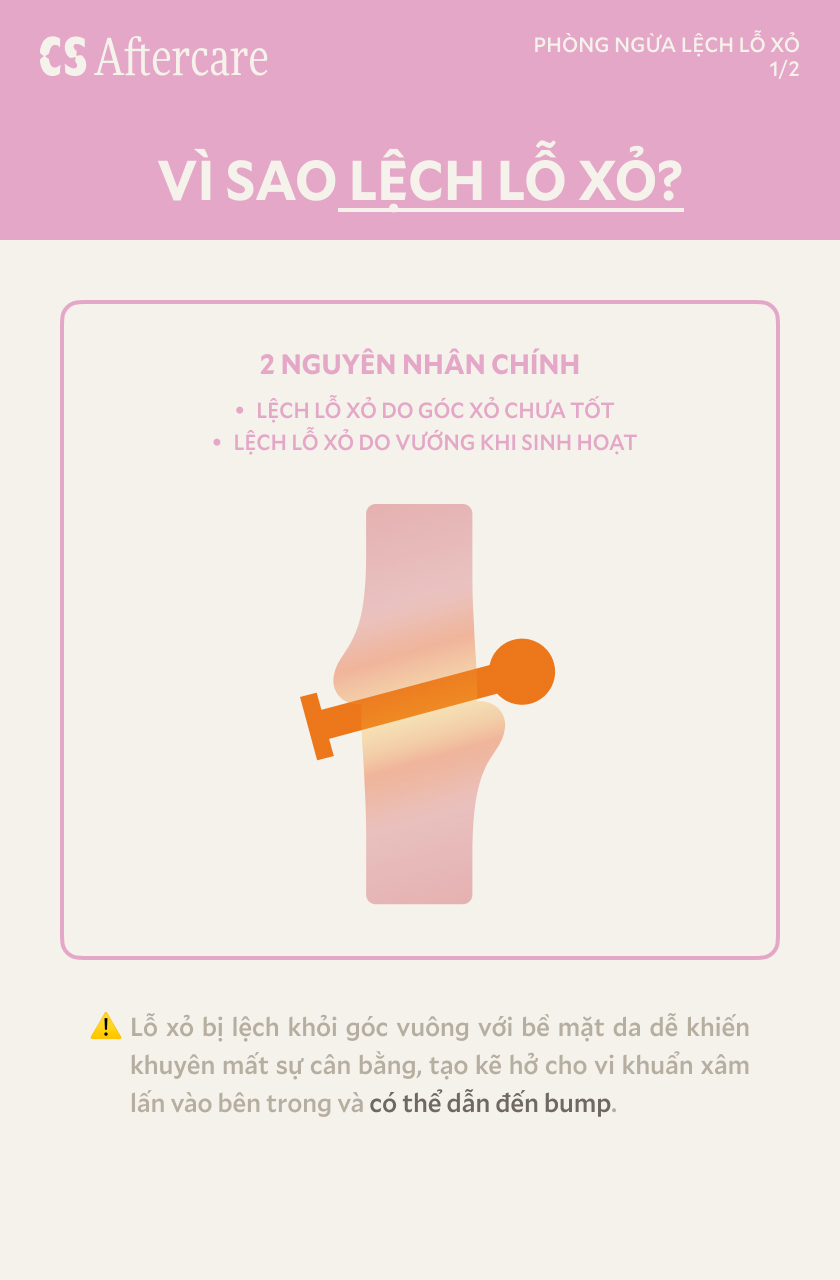 Vì sao lệch lỗ xỏ — 2 nguyên nhân chính